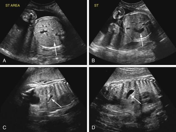 F igure 17-3, Physiologic gastric emptying. A and B, Transient nonvisualization. Initial image of the upper abdomen at 26 weeks gestation does not depict the stomach in expected location in the left upper quadrant ( arrow , image A ). Image obtained in a similar scan plane approximately 20 minutes after obtaining image A shows a normal-appearing stomach ( arrow , image B ) due to the fetus swallowing amniotic fluid in the interval between the two images. C and D, Transient small stomach. C, Longitudinal image of the fetal body early in the third trimester shows a small stomach (arrow) . D, Longitudinal image of the same fetus obtained approximately 25 minutes after obtaining image A shows interval filling of the stomach (arrow), which is now normal in appearance.