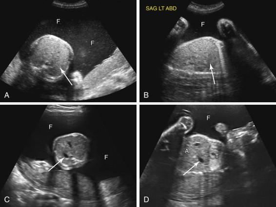 F igure 17-5, Esophageal atresia. A and B, Nonvisualization of the stomach. Axial (A) and left parasagittal (B) images of the fetal abdomen show polyhydramnios (F) and nonvisualization of the stomach in the expected location in the left upper quadrant (arrows) due to esophageal atresia. C and D, Esophageal atresia with tracheoesophageal fistula. Transverse image of the abdomen (image C ) and oblique coronal image of the fetal thorax (T) and abdomen (A; image D ) show a small stomach (arrows) in the left upper quadrant due to partial filling of the stomach by fluid traversing the tracheoesophageal fistula. There is also polyhydramnios (F).