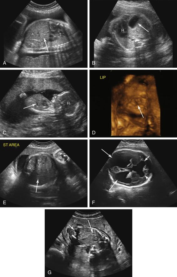 F igure 17-6, Nonvisualized or small stomach: additional etiologies. A and B, Congenital diaphragmatic hernia. Left parasagittal image of the fetal thorax and abdomen (image A ) fails to demonstrate the stomach in its expected location in the left upper quadrant (arrow) . Axial image of the thorax at the level of heart (H, image B ) shows the stomach (arrow) in the left hemithorax due to a congenital diaphragmatic hernia, accounting for failure to identify the stomach in the abdomen. The heart is shifted into the right hemithorax due to mass effect from the herniated abdominal contents. C and D, Small stomach: facial cleft. C, Left parasagittal image of the fetal head (H) and body shows a small stomach (arrow) in the left upper quadrant. D, Three-dimensional surface-rendered image of the fetal face shows a large facial cleft (arrow) that involved the lip, palate, and nose. The cleft interfered with normal fetal swallowing, explaining the small stomach. E and F, Small stomach: neurologic abnormality. Axial image of the upper abdomen (image E ) shows nonvisualization of the stomach in its expected location in the left upper quadrant (arrow) . F, Axial image of the head of the same fetus as in image E demonstrates marked hydrocephalus with dilatation of the frontal (short arrows) and occipital (long arrows) horns of the lateral ventricles due to aqueductal stenosis. Neurologic dysfunction due to the hydrocephalus interfered with fetal swallowing, accounting for nonvisualization of the stomach. G, Small stomach due to oligohydramnios. Oblique image of the gravid uterus at 18 weeks gestation shows marked oligohydramnios due to premature rupture of membranes, with only small pockets of amniotic fluid seen. The stomach (long arrow) is very small due to the decreased volume of amniotic fluid available for the fetus to swallow. Short arrow in G , bladder. A, Abdomen; P, placenta; T, thorax.