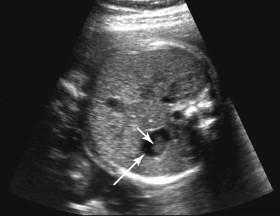 F igure 17-7, Gastric pseudomass. Axial image of the fetal abdomen at 26 weeks shows a normally positioned fetal stomach (long arrow) containing a rounded focal collection of echoes due to swallowed material (short arrow) . The echoes in the stomach resemble a mass, hence the term gastric pseudomass .