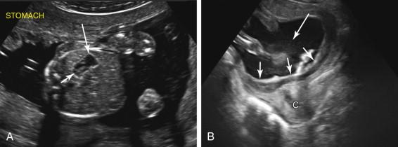 F igure 17-8, Swallowed blood in the stomach. A, Axial image of the fetal abdomen shows the stomach (long arrow) containing echogenic material (short arrow) due to swallowed blood. B, Midline sagittal image of the lower uterus in the same pregnancy as image A shows a subchorionic hematoma with elevated amniochorionic membrane (short arrows) extending over the cervix (C). There are also internal echoes in the amniotic fluid (long arrow) due to blood that extended into the amniotic cavity from the subchorionic hematoma, accounting for the swallowed blood in the fetal stomach.