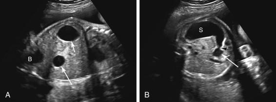 F igure 17-9, Duodenal atresia. A, Coronal image of the fetal body shows a double-bubble sign consisting of dilated stomach (short arrow) in the left upper abdomen and dilated duodenal bulb (long arrow) to the right of midline. The urinary bladder (B) is also seen. B, Axial image of the fetal abdomen shows curved configuration of the fetal stomach (S) emptying into the duodenal bulb (long white arrow) across the pylorus (short black arrow) , confirming the presence of a dilated stomach and duodenal bulb.