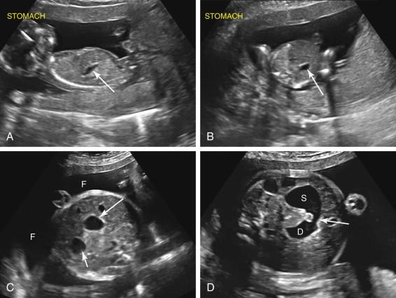 F igure 17-10, Duodenal atresia: not apparent at 16 weeks. A and B, Longitudinal image of the fetus (image A ) and transverse image of the upper abdomen (image B ) show a nondilated stomach (arrows) in normal location in the left upper quadrant, with no evidence of a dilated duodenal bulb. C and D, Duodenal atresia identified later in pregnancy. C, Axial image of the fetal abdomen at 29 weeks in the same patient as in A and B shows the double-bubble sign consisting of stomach in the left upper quadrant (short arrow) and dilated duodenal bulb to the right of midline (long arrow) as well as polyhydramnios (F). D, Axial image in the same patient as in image C after adjusting the scan plane to assess for communication between the components of the double-bubble sign confirms a connection (arrow) between the dilated stomach (S) and duodenal bulb (D). Ultrasound signs of duodenal atresia are frequently not seen early in the second trimester.