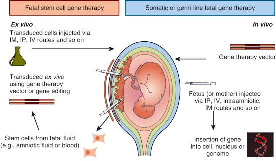 • Fig. 46.1, The fetus can receive gene therapy in a variety of ways. The vector can be directly applied to the fetus or the mother by ultrasound guided injection, called somatic gene therapy. Alternatively, stem cells can be collected from fetal fluid by ultrasound-guided sampling, gene corrected in the laboratory by incubation with the gene therapy vector and then reintroduced back into the fetus by ultrasound guided injection. IM, Intramuscular; IP, intraperitoneal; IV, intravascular.