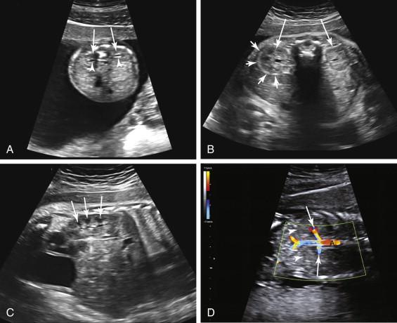 F igure 18-1, Normal fetal kidneys. A, Axial view of the fetal abdomen at 16 weeks gestation shows the fetal kidneys (arrows) in a normal paraspinal location. Identification of a small amount of fluid in the renal pelvis bilaterally (arrowheads) confirms that the kidneys have been visualized. B, Axial image of the fetal abdomen at 31 weeks shows the kidneys (long arrows) in cross section. The margins of the kidneys are easier to recognize in this third-trimester fetus than they are early in the second trimester due to an echogenic peripheral interface from the renal capsule and perinephric fat (short arrows) . C, Longitudinal image of the fetal abdomen and pelvis of the same fetus described in image B shows normal corticomedullary differentiation in the kidney. The medullary pyramids (arrows) are depicted as discrete structures that are less echogenic than the surrounding renal cortex. D, Coronal image with color Doppler of the body of a fetus at 18 weeks gestation shows the bilateral renal arteries (arrows) originating from the abdominal aorta (A) to supply the kidneys (arrowheads) .