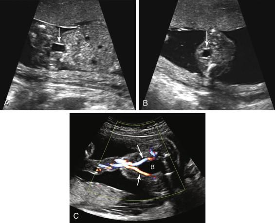 F igure 18-2, Normal fetal bladder. Coronal (A) and axial (B) views of the fetal pelvis show the urinary bladder (arrows) as a midline fluid-filled structure. C, Axial image with color Doppler of the fetal pelvis and fetal umbilical cord insertion shows intra-abdominal extensions of the umbilical arteries (arrows) along the lateral margins of the bladder (B).