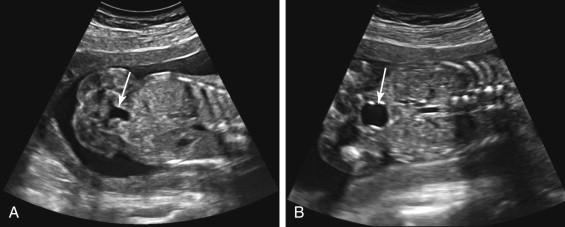 F igure 18-3, Cyclical changes in the size of a normal fetal bladder. A and B, Coronal images of the fetal abdomen and pelvis show normal change in the size of the fetal bladder (arrows) during the course of an ultrasound examination. A very small bladder is seen soon after fetal urination (A) and a moderate size bladder (B) is visualized later in the examination.
