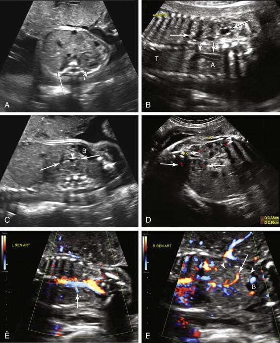 F igure 18-4, Pelvic kidney. A, Nonvisualization of the right kidney in the expected location. Axial image of the fetal abdomen at 26 weeks gestation shows the normal paraspinal location of the left kidney (short arrow) . No kidney is seen in the right renal fossa (long arrow) . B, The lying down adrenal sign. Coronal image of the fetal thorax (T) and abdomen (A) of the same fetus described in image A shows flattened, elongated configuration of the right adrenal gland (short arrows) in the renal fossa. The lying down adrenal gland should not be mistaken for a kidney. The left kidney (long arrows) is seen in its expected location. C, Ectopic pelvic kidney. Right parasagittal image of the fetal abdomen and pelvis of the same fetus described in images A and B shows the right pelvic kidney (arrows) adjacent to the urinary bladder (B). A small amount of fluid is seen in the renal pelvis (arrowhead) . D, Right pelvic kidney and normally located left kidney. Longitudinal image of the fetal abdomen and pelvis obtained 6 weeks after images A through C shows both the right pelvic kidney (long arrows) and the normally located left kidney (arrowheads) on the same image. E, Left renal artery. Coronal image with color Doppler of the body of the same fetus shows the left renal artery (arrow) coursing from the aorta to the normally located left kidney. F, Right renal artery. Coronal image with color Doppler of the fetal body in a scan plane anterior to that in image E shows the right renal artery (arrow) supplying the right pelvic kidney (arrowheads) . The urinary bladder (B) is seen adjacent to the pelvic kidney. LK, Left kidney; RK, right kidney.