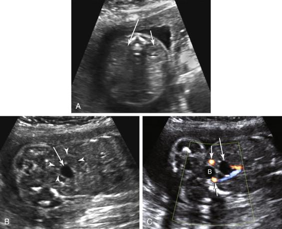 F igure 18-5, Pelvic kidney with a dilated renal pelvis. A, Axial image of the fetal abdomen shows the left kidney (short arrow) in normal location. No kidney is identified in the right renal fossa (long arrow) . B, Coronal image of the fetal abdomen and pelvis shows a small fluid collection (arrow) corresponding to the dilated pelvis of a right pelvic kidney (arrowheads) . C, Oblique image with color Doppler of the pelvic kidney of the same fetus described in images A and B shows no blood flow in the dilated pelvis (long arrow) of the pelvic kidney. The urinary bladder (B) is separate from the renal pelvis. The intra-abdominal extensions of the umbilical arteries are seen in cross section (short arrows) on both sides of the urinary bladder.