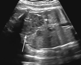 F igure 18-6, Crossed fused ectopia. Coronal image of the fetal abdomen and pelvis shows an ectopic kidney in a midline pelvic location (long arrow) , fused to the lower pole of the contralateral kidney (short arrow) .