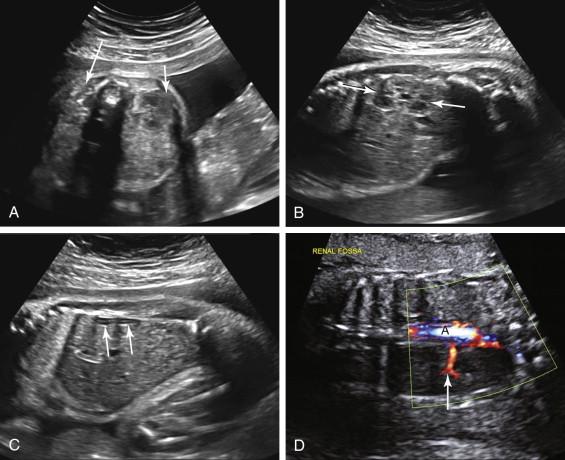 F igure 18-7, Unilateral renal agenesis. A, Axial image of the fetal abdomen at 28 weeks gestation shows the normally located right kidney (short arrow) . No kidney is identified in the left renal fossa (long arrow) . B, Right parasagittal image of the fetal abdomen shows the right kidney in a longitudinal scan plane (arrows) , confirming its normal location. C, Left parasagittal image of the fetal abdomen shows a left-sided lying down adrenal sign (arrows) , due to absence of a kidney in the left renal fossa. D, Coronal image of the fetal abdomen with color Doppler shows the right renal artery (arrow) extending from the aorta (A) to the right kidney. No left renal artery is seen.