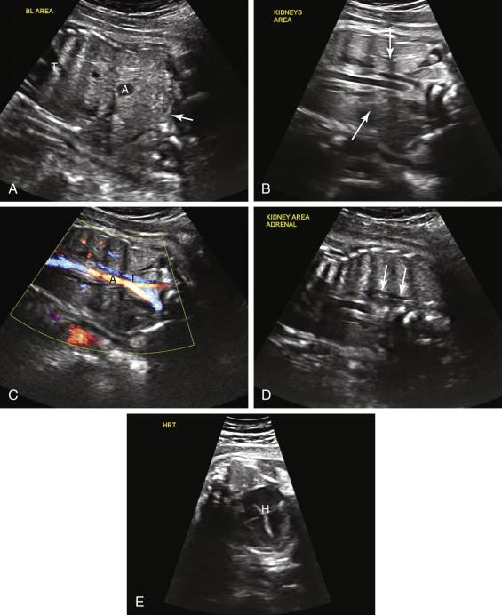 F igure 18-8, Bilateral renal agenesis. A, Coronal image of the fetal thorax (T) and abdomen (A) demonstrates failure to identify the urinary bladder in its expected location (arrow) due to lack of fetal urine production. B, Coronal image in scan plane obtained posterior to image A , in the expected location of the bilateral renal fossa, demonstrates inability to identify the kidneys (arrows) . C, Coronal image with color Doppler in a similar scan plane as in image B shows the aorta (A) and the inferior vena cava (I). The bilateral renal arteries are not visualized. D, Oblique image of right renal fossa shows the lying down adrenal sign (arrows) in the right renal fossa. E, Pulmonary hypoplasia. Axial image of the fetal thorax shows the heart (H) occupying a disproportionately large portion of the thorax due to small chest size secondary to pulmonary hypoplasia.