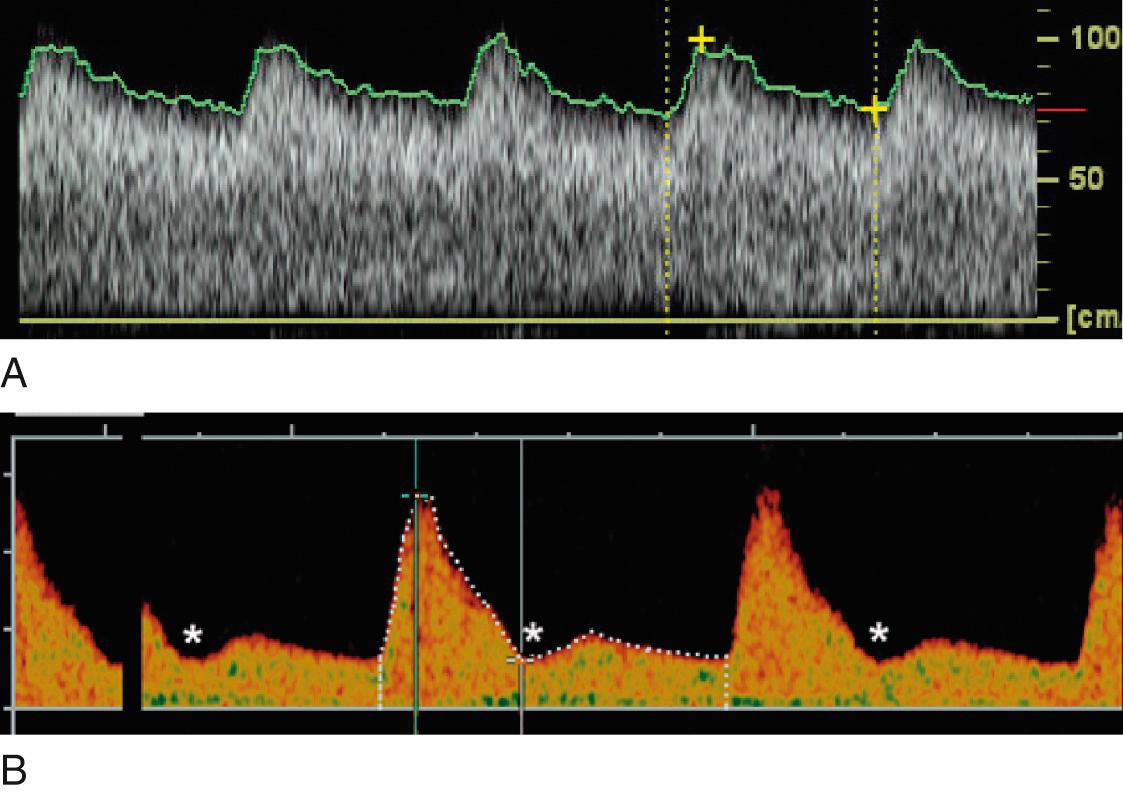 Fig. 30.2, Uterine Artery Flow-Velocity Waveforms.