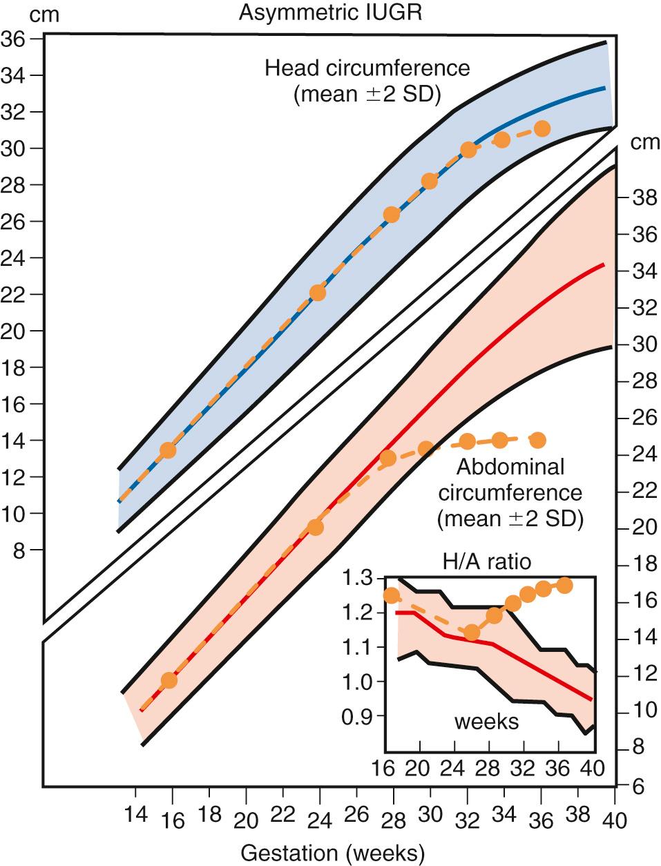 Fig. 30.4, Growth Chart in a Case of Asymmetric Intrauterine Growth Restriction.