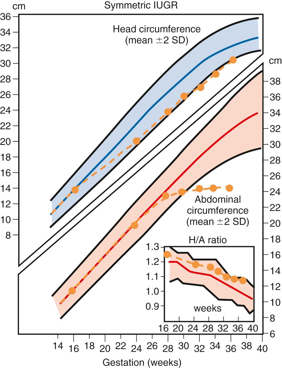 Fig. 30.5, Growth Chart in a Case of Symmetric Intrauterine Growth Restriction.