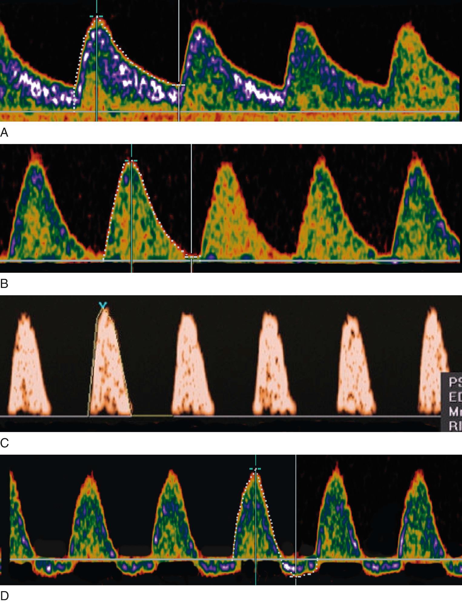 Fig. 30.6, Umbilical Artery Flow-Velocity Waveforms.