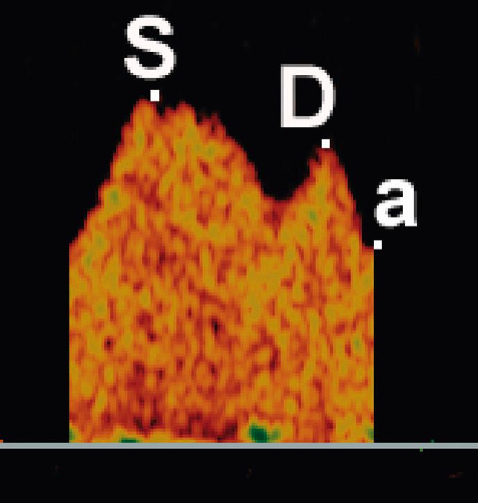 Fig. 30.7, Venous Flow-Velocity Waveform.