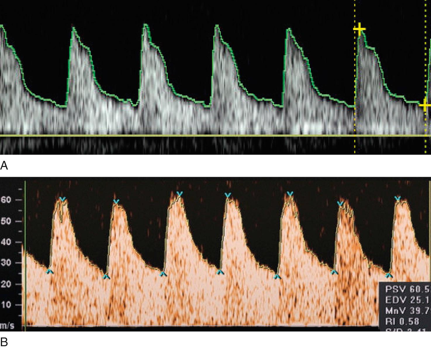 Fig. 30.8, Middle Cerebral Artery Flow-Velocity Waveform.