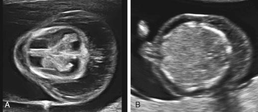 • Fig. 36.1, Axial sections of the head ( A ) and abdomen ( B ) of a first trimester fetus with significance skin oedema.