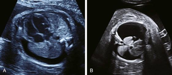 • Fig. 36.2, A, Moderate pleural effusion that is essentially unilateral. B, Severe bilateral pleural effusion.