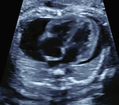 • Fig. 36.3, Transverse four-chamber view of the heart showing an abnormal pericardial effusion.