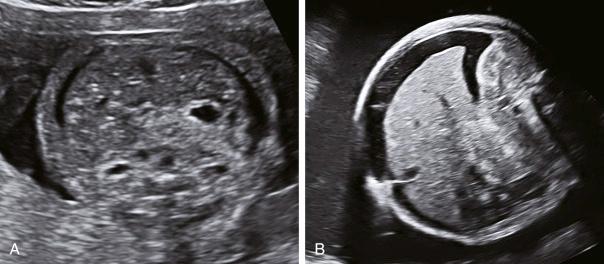 • Fig. 36.4, Axial sections of the fetal abdomen showing a subtle rim ( A ) and a moderate collection of fetal ascites ( B ).