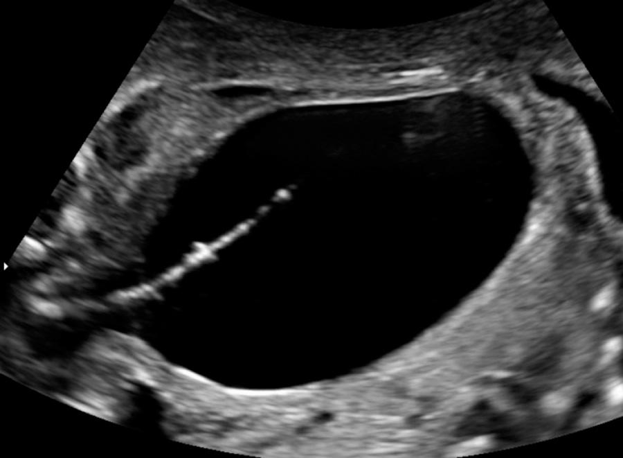 Fig. 116.1, Ultrasound image showing fetoscopic placement of a transurethral vesicoamniotic shunt in a patient with posterior urethral valves.