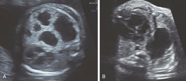 • Fig. 30.1, A, Axial view through the chest of a fetus at 22 weeks with multiple cystic lesions in the chest. Note the shift and compression of the heart. B, A single cyst is seen in the axial view with some mediastinal shift.