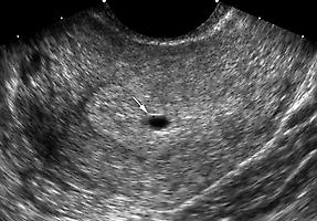 FIG. 42.1, Gestational Sac.