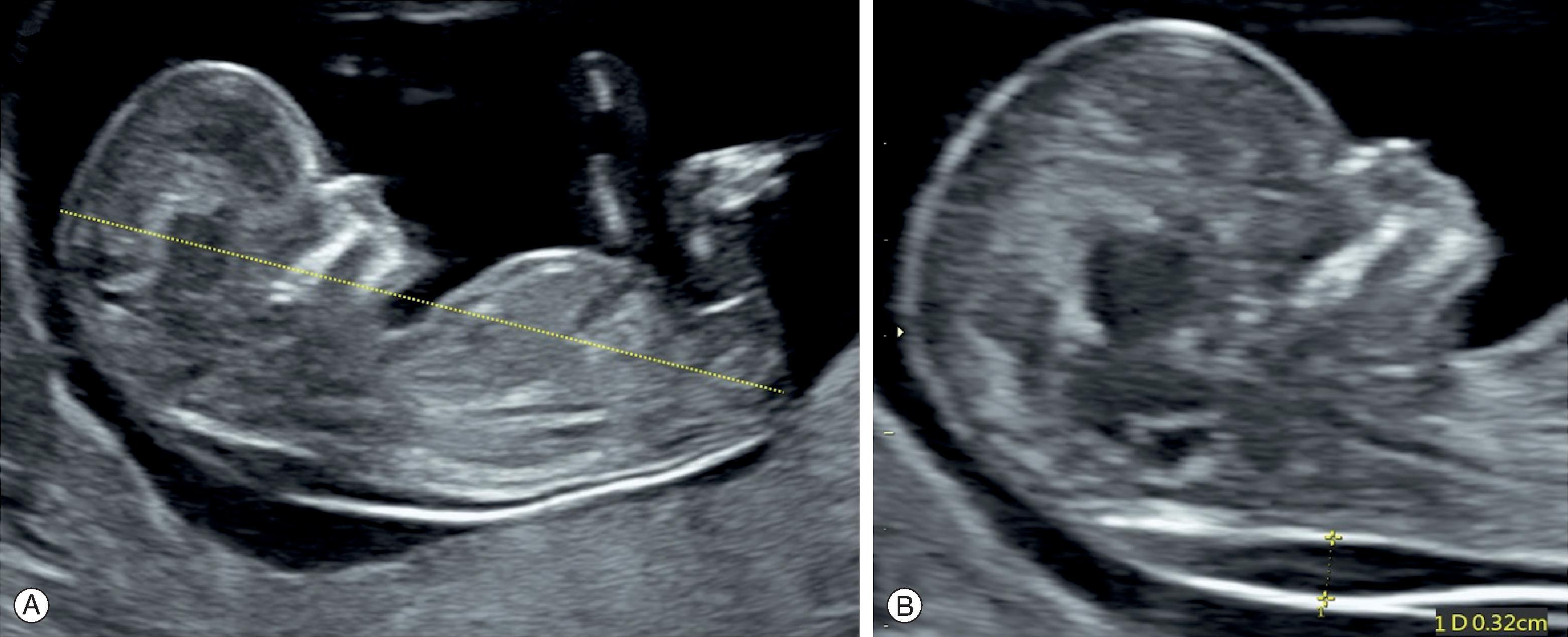 Fig. 25.1, The sagittal view required for a crown-rump length for accurate dating of gestational age (A) and to measure the nuchal translucency between the on-screen calipers (B) .