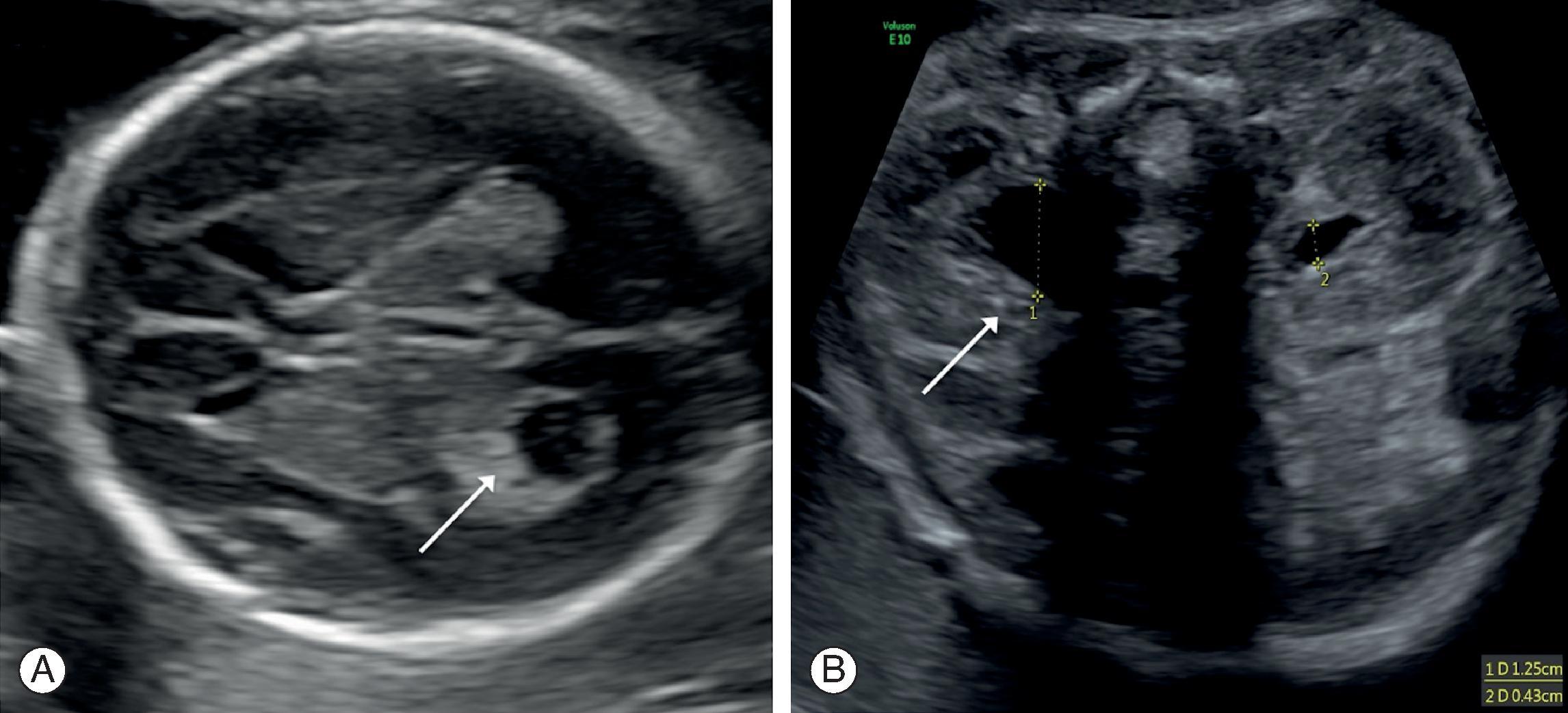 Fig. 25.2, (A) Unilateral choroid plexus cyst and (B) unilateral mild renal pelvis dilatation, both in karyotypically normal fetuses.