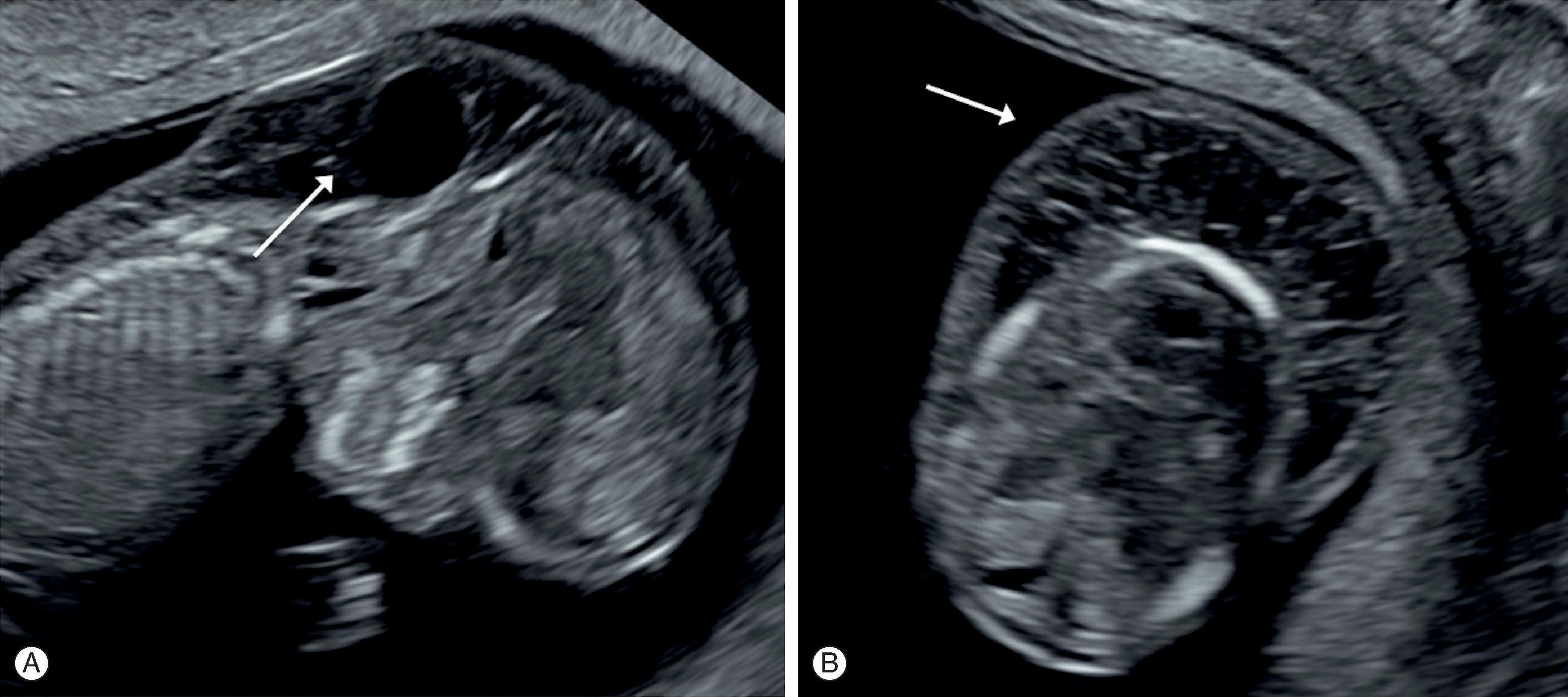 Fig. 25.3, A cystic hygroma. The nuchal translucency is increased due to large loculated cystic swelling behind the fetal neck on a sagittal view (A) and an axial view of the fetal neck and head (B) .