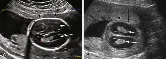 F igure 19-1, Calvarial mineralization. A, Normal. Axial image of the fetal head at the level of the lateral ventricles shows a highly echogenic calvarium (black arrows) consistent with normal calvarial mineralization. Reverberation artifact from the calvarium prevents visualization of the near-field lateral ventricle (short white arrow), whereas the lateral ventricle in the far field is visualized (long white arrow ). B, Hypomineralization. Axial image of the head at the level of the lateral ventricles in a fetus with markedly decreased calvarial mineralization (black arrows) due to osteogenesis imperfecta shows better-than-expected sonographic visualization of the brain in the near field. Both the near-field (short white arrow) and far-field (long white arrow) lateral ventricles are seen.