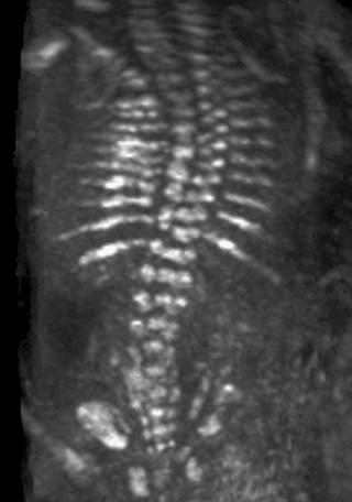 FIG 11-11, Three-dimensional ultrasound image of the fetal spine showing scoliosis.