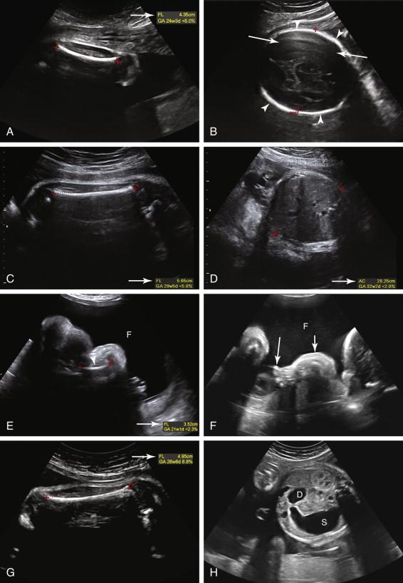 F igure 19-12, Short femur: differential diagnosis. A and B, Constitutionally short femur. A, Femur length of 4.35 cm is below the fifth percentile for gestational age (arrow) . Estimated fetal weight, head measurements, and abdominal circumference were within normal range for gestational age and no other fetal abnormalities were seen. B, View of the head obtained to measure biparietal diameter in same fetus as in image A shows normal calvarial mineralization with an echogenic calvarium (arrowheads). The normal calvarial mineralization causes reverberation artifact that hinders visualization of intracranial anatomy in the portion of the brain closest to the transducer (long arrows) . Both the mother and father of the fetus were of short stature. Findings at birth were consistent with a constitutionally short normal fetus. C and D, Short femur: fetal growth restriction. C, Femur length of 5.65 cm is below the fifth percentile for gestational age (arrow) . D, Abdominal circumference (arrow) in the same fetus as in image C is less than the second percentile for gestational age. Likewise, the estimated fetal weight was also less than the third percentile and there is severe oligohydramnios. No skeletal deformities other than short limbs were seen consistent with growth restriction. E and F, Short femur: skeletal dysplasia. E, Femur is markedly short (arrowhead) measuring below the 2.3rd percentile for gestational age (arrow) . In addition, there is polyhydramnios (F) . F, Image of the same fetus as in image E confirms the presence of polyhydramnios (F) and shows a markedly abnormal forearm with short stubby fingers (long arrow) and thickened soft tissues (short arrow) due to a lethal skeletal dysplasia. By contrast, when a short femur is secondary to growth restriction (as in images C and D ) oligohydramnios is more likely than polyhydramnios. G and H, Short femur: trisomy 21. G, Femur length is mildly short, measuring at the 8.8th percentile for gestational age (arrow) . Humerus length was similarly short. H, Axial image of the abdomen in the same fetus as in image G shows a dilated stomach (S) and duodenal bulb (D) secondary to duodenal atresia. Fetal karyotype was trisomy 21. Short femur and short humerus are common findings in trisomy 21.