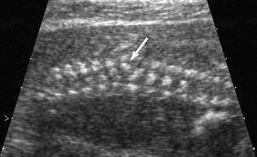 FIG 11-12, Coronal scan of the fetal spine showing lateral hemivertebra ( arrow ) in the thoracic segment.