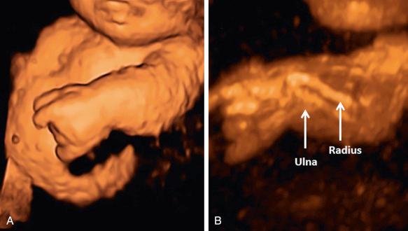 FIG 11-15, Comparison between the surface rendering mode ( A ) and the maximum intensity projection mode ( B ) for visualization of the fetal arm in a fetus with mesomelic shortening of the long bones. Using the maximum intensity projection mode, only voxels with the highest intensity are displayed, thus allowing a clear representation of the mesomelic shortening of the radius and ulna.