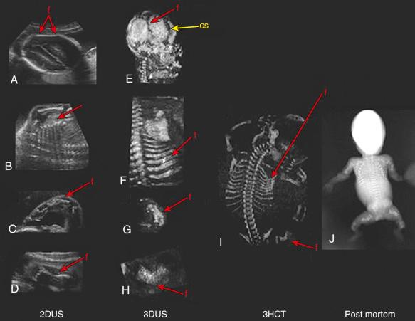 FIG 11-16, Comparison of phenotypic features of osteogenesis imperfecta by three-dimensional helical computed tomography (3HCT), three-dimensional ultrasound (3DUS) images, two-dimensional ultrasound (2DUS) images, and postmortem radiographs. A, 2DUS: transverse section of fetal head with a skull fracture (f) deformed by the transducer pressure. B, 2DUS: coronal section of fetal thorax showing irregular ribs ( arrow ). C, 2DUS: sagittal section of the right superior limb showing a short and bowed arm. D, 2DUS: sagittal section of fetal femur with a fracture (f). E, 3DUS image showing lateral view of fetal skull with a fracture (f) that could be differentiated from a normal coronal suture (CS) by the location and the abnormal shape depending on the transducer pressure; this was confirmed by postmortem examination. F, 3DUS-rendered bone mode demonstrating posterior view of fetal thorax showing fractured and irregular ribs (f). G, 3DUS-rendered bone mode image showing short and bowed radius and ulna. H, 3DUS-rendered bone mode image showing a fractured femur (f). I, 3HCT: posterior view of entire fetus confirming fractures (f) of ribs and femur as well as decreased mineralization of the skull. J, Postmortem radiologic examination, confirming shortening, bowing, and fracture of long bones.