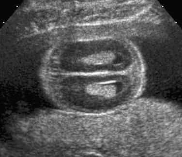 FIG 11-17, Demineralization of the skull in a case of osteogenesis imperfecta. The lateral ventricle and choroid plexus in the near field are well visualized because of lack of normal mineralization of the calvarium. In normal fetuses, reverberation artifact from the calvarium would obscure the ultrasound image of these structures.