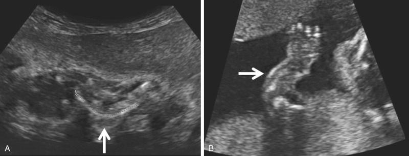 FIG 11-18, Bowing of long bones of the limbs ( arrows ) in fetuses with campomelic dysplasia ( A ) and with thanatophoric dysplasia ( B ).