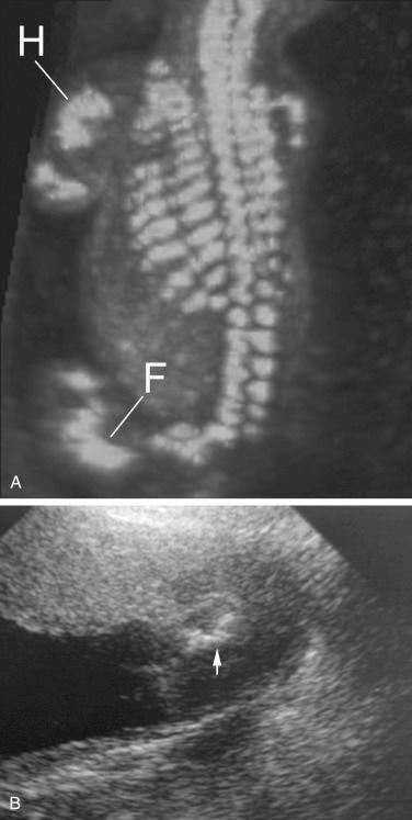 FIG 11-19, A, Three-dimensional sonogram in a fetus with osteogenesis imperfecta type II. The volume dataset was rendered using the maximum intensity mode. Multiple fractures in the ribs are present. Note the severe bowing and shortening of the femur (F) and humerus (H). B, Sonogram of a fetus with osteogenesis imperfecta type II. The femur is markedly shortened ( arrow ) with multiple fractures.