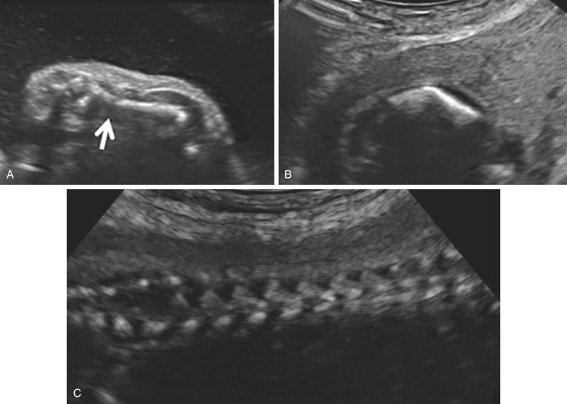 FIG 11-20, In utero fracture ( A ) and bowing ( B ) of the long bones in a fetus with osteogenesis imperfecta. The arrow indicates the hypoechogenic fracture line. Hypomineralization of the spine is shown in the longitudinal view ( C ).