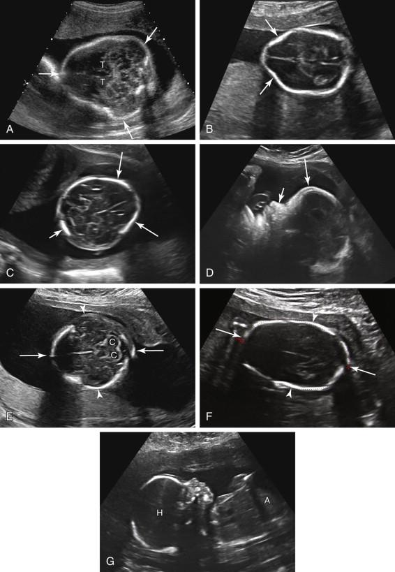F igure 19-2, Calvarial shape. A, Cloverleaf. Axial image of the fetal head at the level of the thalami (T) shows the cloverleaf configuration of the skull (arrows) in a fetus with type II thanatophoric dysplasia. B, Lemon. Axial image of the head of a second trimester fetus with Chiari II malformation shows flattening and mild concavity of the frontal bones (arrows) resulting in a lemon-shaped calvarial configuration. C, Strawberry. Axial image of the head of a second-trimester fetus with trisomy 18 shows flattening of the occiput (short arrow) and flattening of the frontal bones (long arrows) causing a strawberry-shaped configuration to the skull. D, Frontal bossing. Midline sagittal profile view of a third-trimester fetus with Chiari II malformation and hydrocephalus (not shown) demonstrates an unusually prominent protruding forehead (long arrow) consistent with frontal bossing ( short arrow , nose). E, Brachycephaly. Axial image of the fetal head at the level of the cerebellum (C) demonstrates a disproportionately wide head (arrowheads) relative to the anteroposterior (AP) diameter (arrows) resulting in a short, rounded calvarial contour, consistent with brachycephaly. F, Dolichocephaly. Axial image of the fetal head during the second trimester shows a disproportionately long AP diameter of the head (arrows) relative to the width of the head (arrowheads) consistent with dolichocephaly. G, Breech presentation associated with dolichocephaly. Midline longitudinal image of the head and abdomen of the same fetus as in image F shows the fetus in breech presentation. Dolichocephaly can occur in the setting of breech presentation. A, Fetal abdomen; H, fetal head.