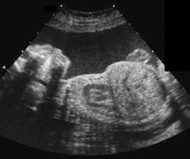 FIG 11-21, Longitudinal section of a fetus with thanatophoric dysplasia. Note the significant disproportion between the chest and abdomen.