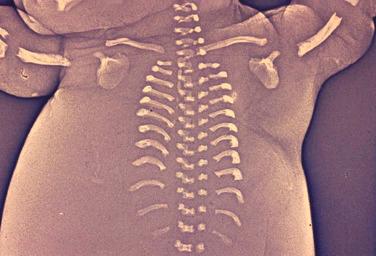 FIG 11-22, Extremely short ribs in a fetus with short rib–polydactyly syndrome.