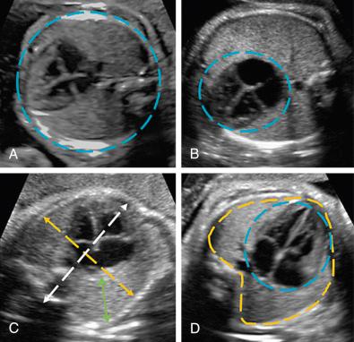 FIG 11-23, Illustration of the various methods to measure thoracic, lung, and heart dimensions. A, Thoracic circumference. B, Cardiac circumference. C, Lung diameter/thoracic area ratio. D, Cardiac area/lung area ratio.