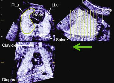 FIG 11-24, Three-dimensional ultrasound fetal lung measurements using the multiplanar technique. Note the image sequences ( green vertical lines ) used to obtain transverse views of the lung. The right lung (RLu) is outlined. Fetal lung volume is obtained by scrolling through the transverse plane ( green arrow ). LLu, left lung.