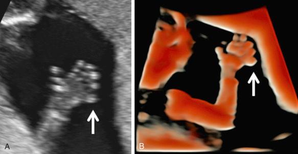 FIG 11-26, Two-dimensional ( A ) and three-dimensional ( B ) ultrasound-rendered volume using HDlive mode showing postaxial polydactyly ( arrow ).