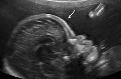 FIG 11-28, Frontal bossing ( arrow ) in a sagittal plane of a fetus with achondroplasia.