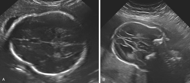 FIG 11-29, Mild cloverleaf skull in a patient with thanatophoric dysplasia. A, Cross-sectional plane. B, Coronal plane.